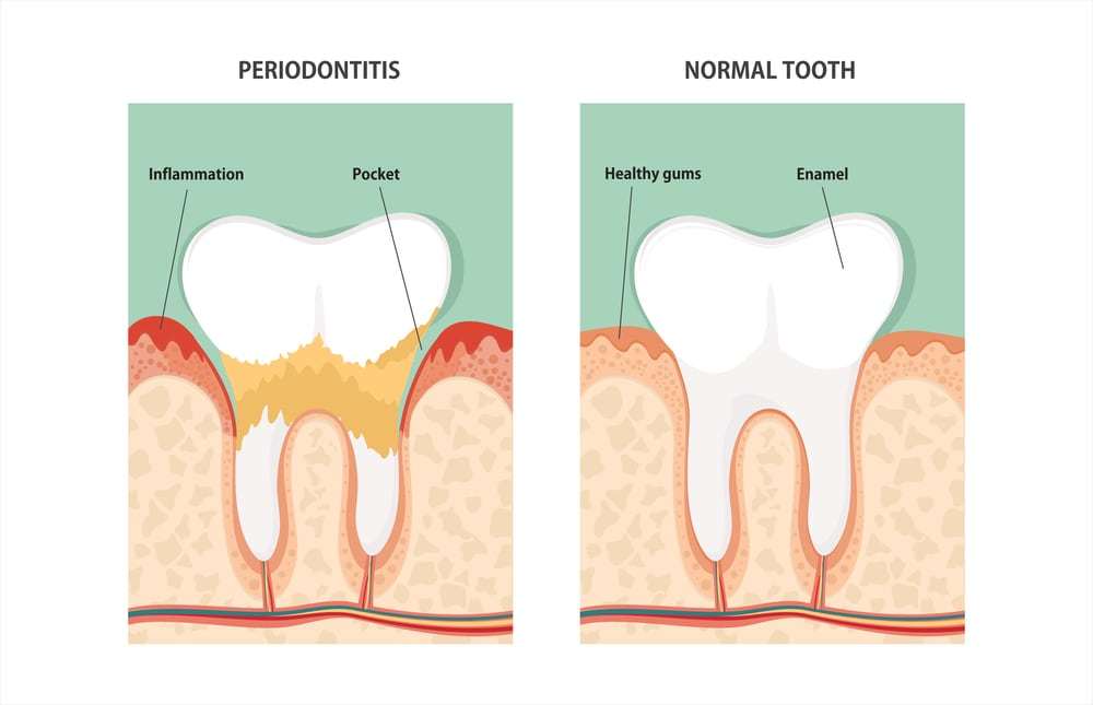 Normal Tooth and Periodontitis Tooth