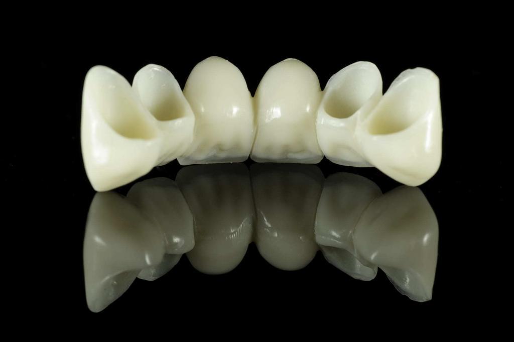 Dental Bridge with 4 Crowns and 2 False Teeth