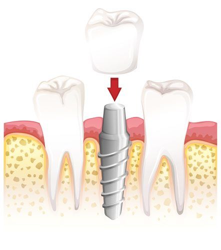 Are Dental Implants Painful?