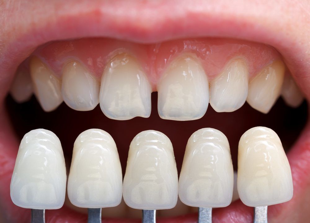 Shade determination with the help of a shade guide for veneers