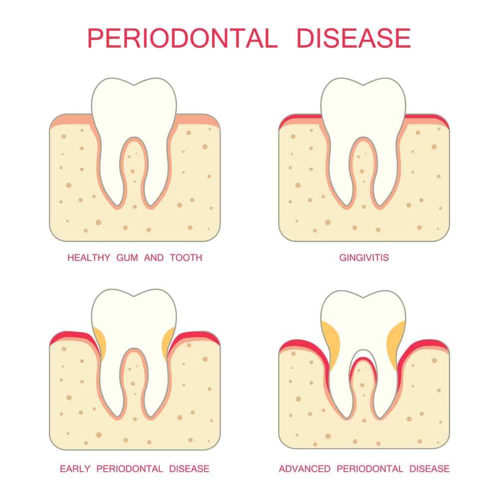 Illustration of the phases of periodontal disease