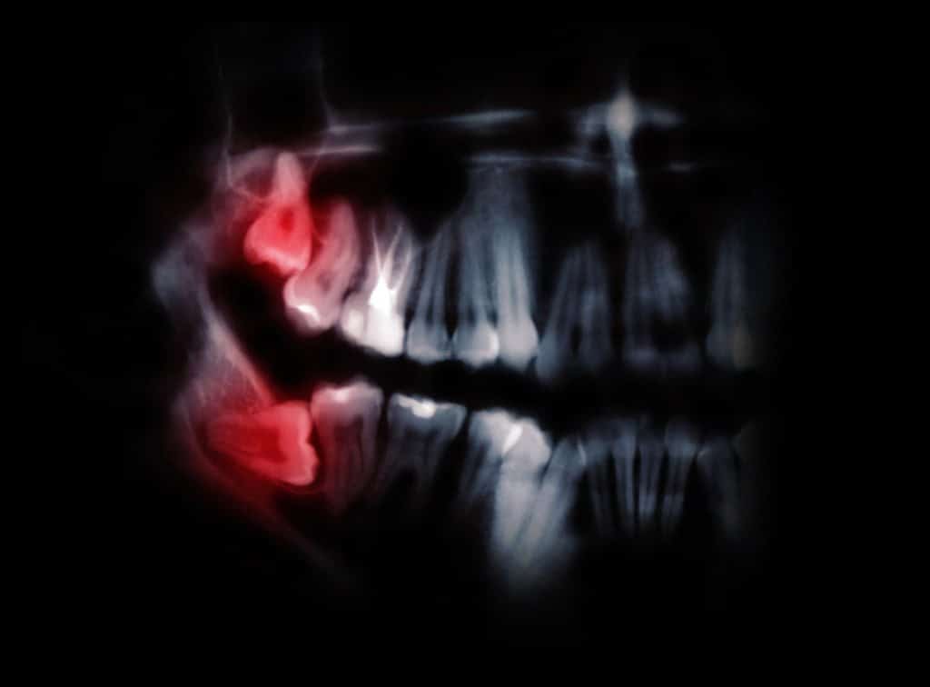Horizontal wisdom teeth pointed out by red spots