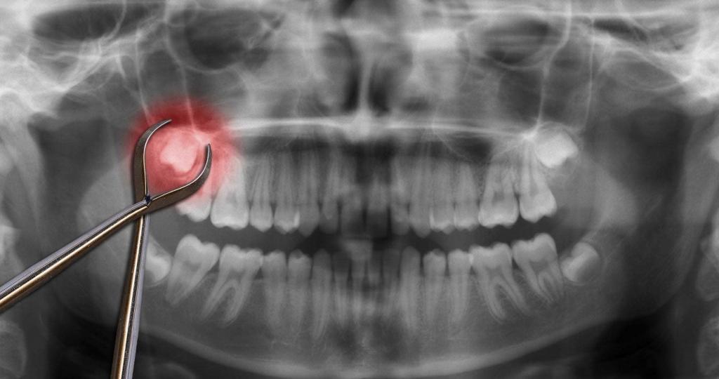 X-ray showing wisdom teeth, extraction tool on top, tooth shaded red