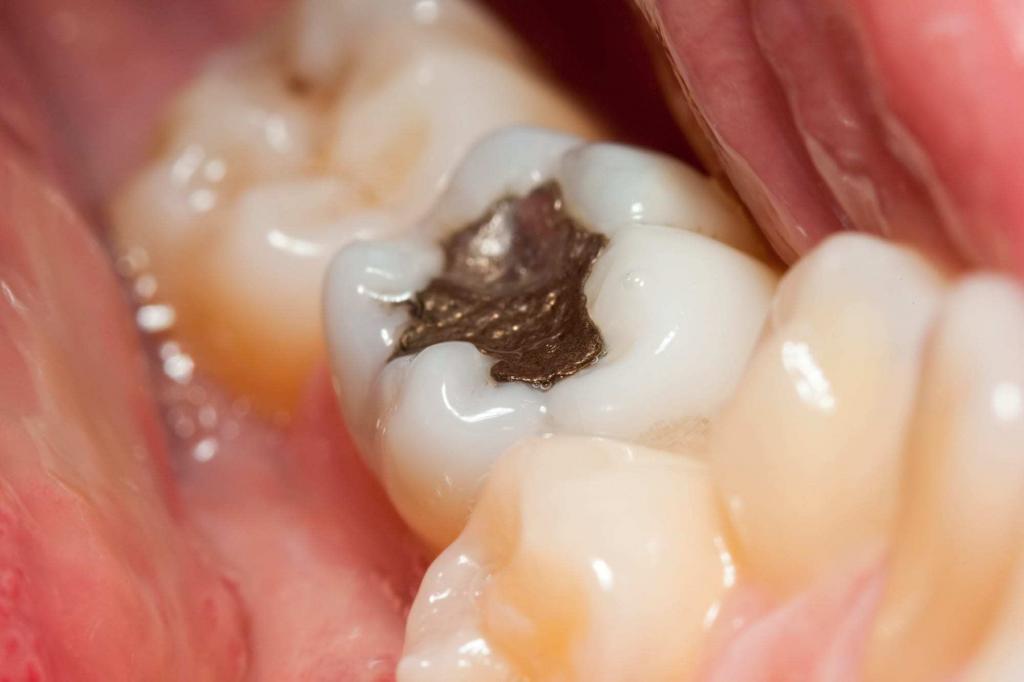 close-up of amalgam filling in tooth