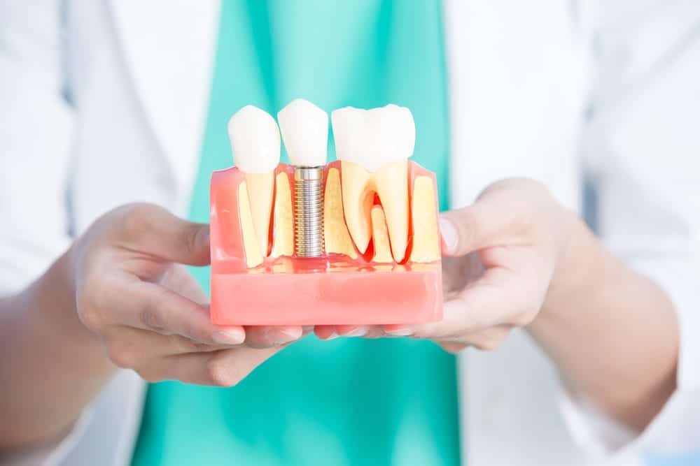 Close-up of dentist holding a model of a dental implant between two natural teeth