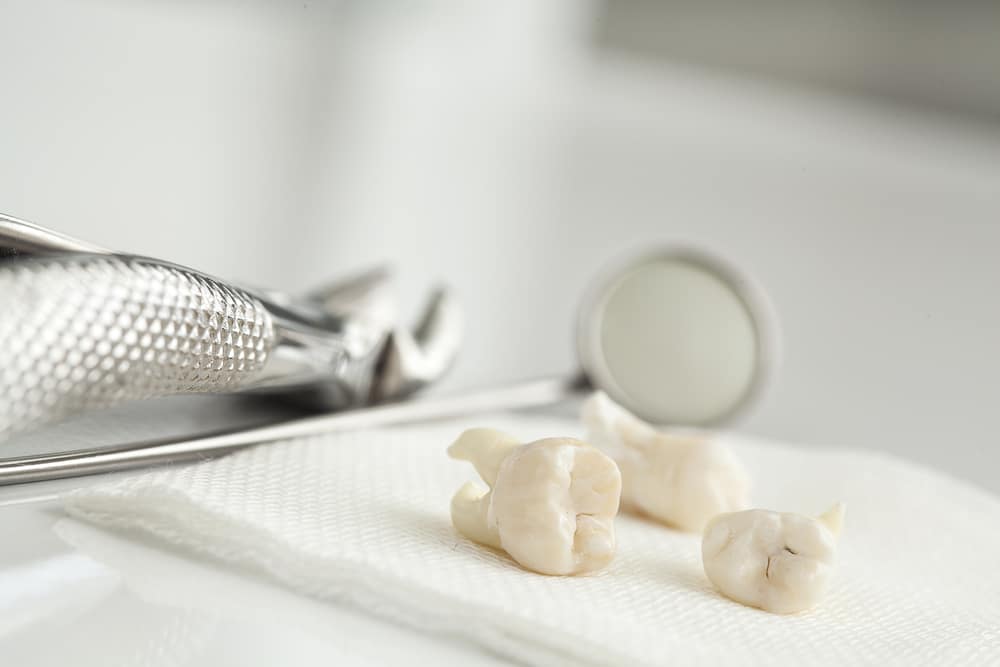 Extracted wisdom teeth on white paper towel, dental tools behind