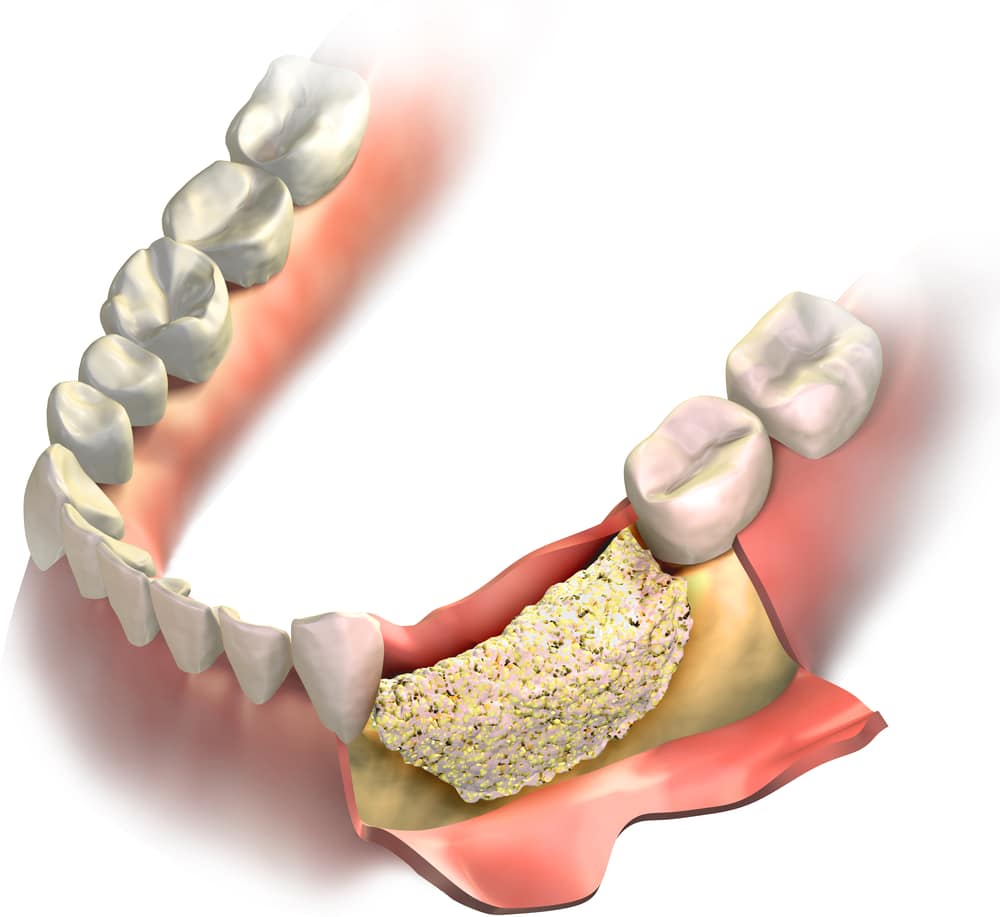 Graphic of bone graft placed on bone loss in jaw, open gum