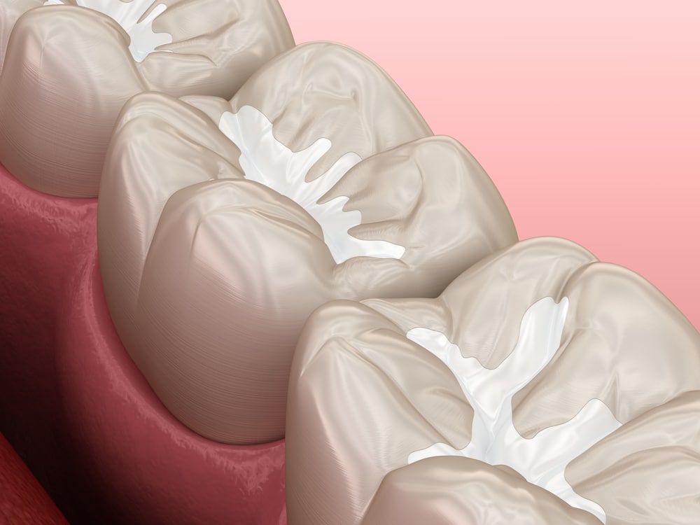 Graphic of dental sealant on molars