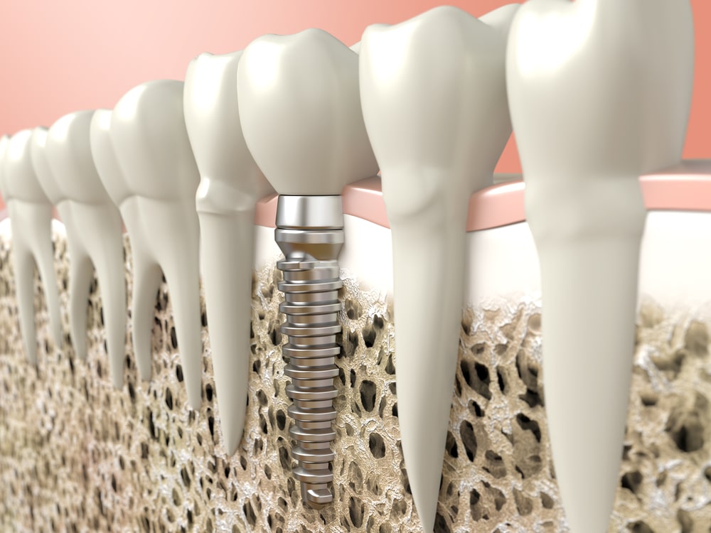 graphic illustration of dental implant surrounded by natural teeth