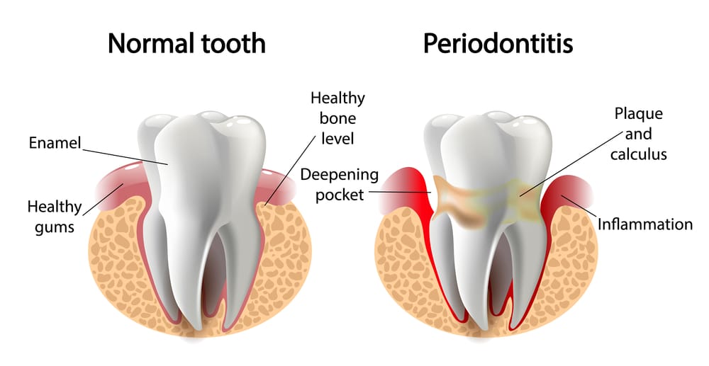 Graphic illustration of healthy tooth and periodontitis