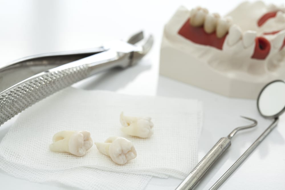 Three extracted teeth on gauze beside dental extraction tools