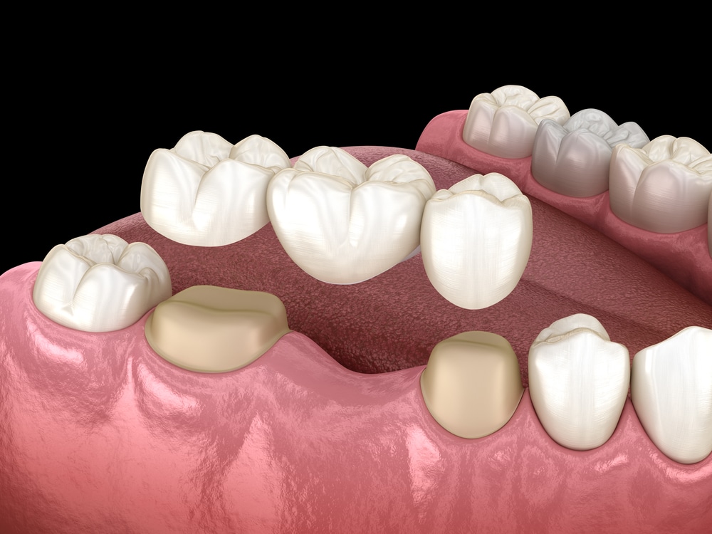Graphic illustration of dental bridge over molar and premolar teeth