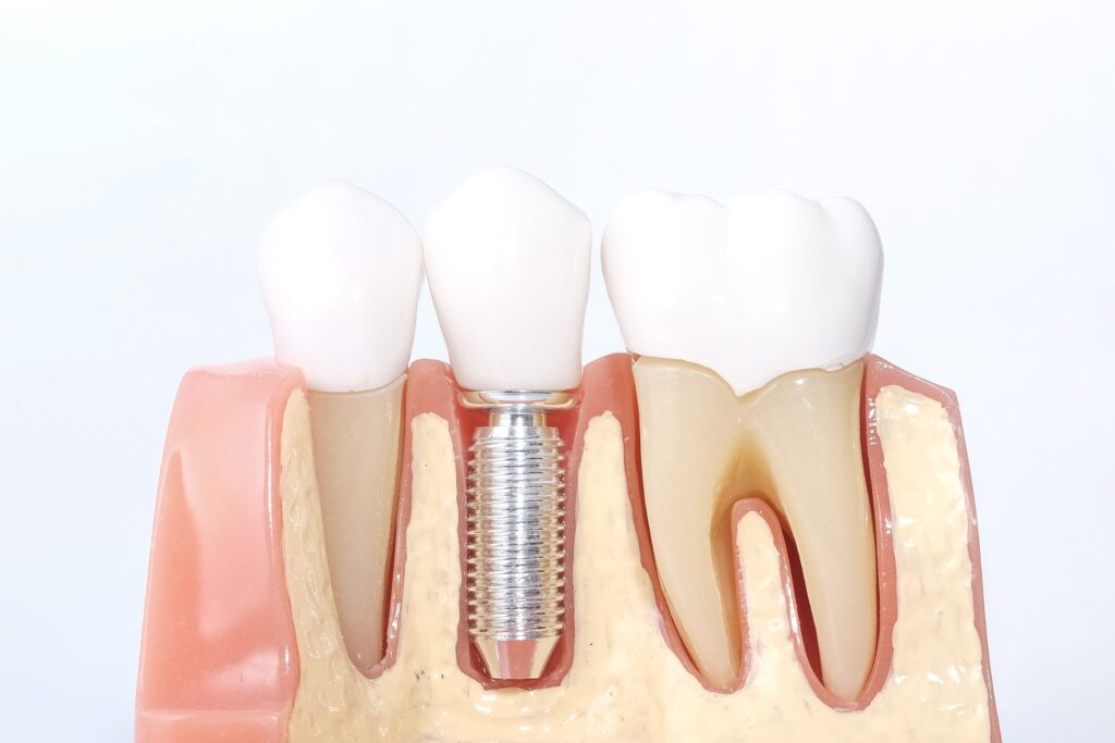 Model of three teeth, two natural and one implant with a crown