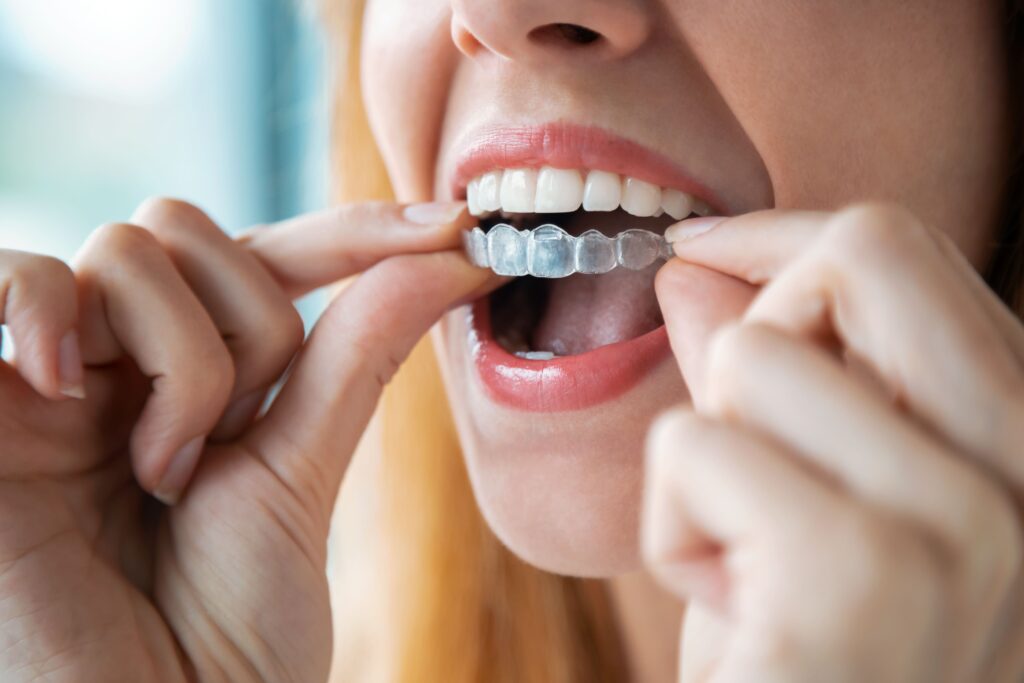 How Frequently Should I Clean My Invisalign?
