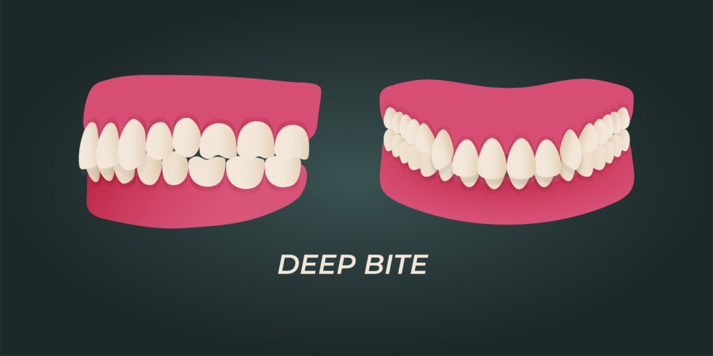 https://www.wilkdental.com/wp-content/uploads/2024/02/Graphic-illustration-of-overbite-aka-deep-bite-side-and-front-views-1024x512.jpg