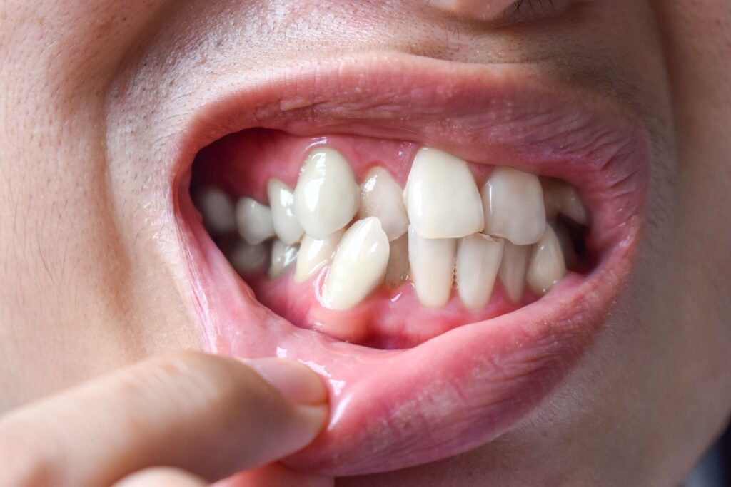 Close-up of crowded teeth