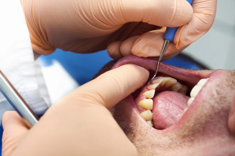 Close-up of dentist examining teeth of patient